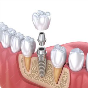 Dental Implants